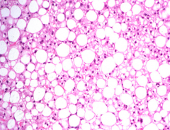 Fatty Liver / Steatosis:
- 90-100% progress from normal liver
- Induced by IL-8 and TNF-α (from Kupffer cells)
- No inflammatory cells here