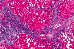 Cirrhosis
- 8-20% directly progress from Fatty Liver
- ~40% of those w/ Alcoholic Hepatitis
- Scar tissue forms nodules