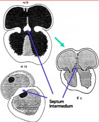 - They fuse to form a centrally positioned mass of cushion tissue = Septum Intermedium
- Results in separate right and left AV canals connected to appropriate ventricle