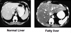 - Normal: spleen and liver are the same color
- Fatty liver: liver is darker than spleen
