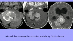 Medulloblastoma with Extensive Nodularity 
Better Prognosis than Conventional MB
More Differentiated