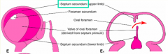 Formation of the Septum Secundum and Foramen Ovale:
- Ridge (superior interatrial fold) grows downward forming the septum secondum
- Septum secundum is incomplete at its inferior border defining an opening called the Oval Foramen