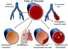 fate of thrombi picture