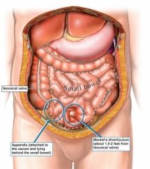 

is a slight bulge in the small intestine present at birth and a vestigial remnant of the omphalomesenteric duct (also called the vitelline duct or yolk stalk)