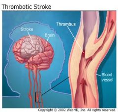 A stroke that occurs because of a clot in an artery that supplies the brain or in intracranial vesicles. This can can due to atherosclerosis and inflammatory disease processes. 