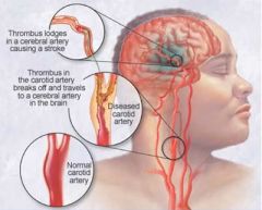 A stroke that occurs when fragments from a thrombus (clot) that is formed outside the brain break off. 

A secondary stroke usually occurs.
