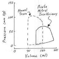 The volume in LV decreases during early systole. 
volume loop is not isovolumetic
Pressure volume loop is small