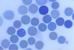 What microcytic anemia is characteristic of these "golf ball" cells?
