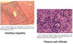 - Interface hepatitis (lymphoplasmacytic infiltrate)
- Portal plasma cell infiltration