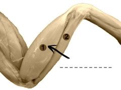 A large muscle a the posterior side of the shank. It is covered with fascia.
