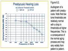 bilateral sloping high frequency sensorinueral hearing loss 
loss of OHC function then IHC function
no treatment other than a hearing aid 
