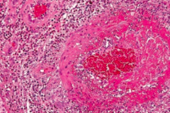 Churg-Strauss Syndrome - small-vessel vasculitis
- Granulomatous, necrotizing vasculitis with eosinophilia
- MPO-ANCA / p-ANCA
- ↑ IgE level