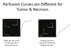 Two Postop Tumor
Both Enhance
Perfusion Curve differeniates
Steep Curve=tumor
Gentle Curve=Related Necrosis