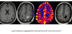 Perhaps Permeability is better than Perfusion for Brain Tumor Recurrence-
Permeability on Purple Margins last image- Permeability New software