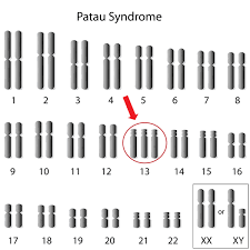 The condition in which there are three homologous chromosomes in place of a homologous pair.