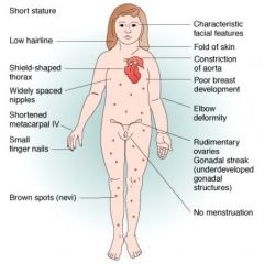 What is turner's syndrome?