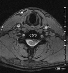 A 49-year-old male presents with left arm pain of four weeks duration. A T2-weighted axial MRI is shown in Figure A. Which of the following statements would most accurately describe his diagnosis and physical exam findings?


1.  A C5 radiculo...