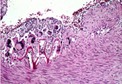 Can you describe the microscopic pathology in this artery?
