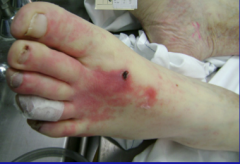 Can you describe the gross pathology in this foot?
Can you diagnose the disease?
Can you guess the pathogenesis?