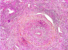 Can you describe the microscopic pathology in this small artery and vein in a lung?