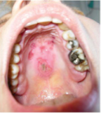 How often do you examine the roof of the mouth
 in physical examination?

What is happening here?

What is the diagnosis and what other
 manifestations will the patient likely have?