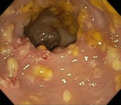 1. profuse watery diarrhea (usually NO blood or mucus)
2. crampy abdominal pain
3. Toxic megacolon (in severe cases) with risk of perforation