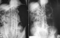 1. chronic illness, age, institionalization, and CNS disease increase the risk of sigmoid volvulus
2. cecal volvulus- due to congenital lack of fixation of the right/descending colon and tends to occur in younger patients
3. chronic constipation...