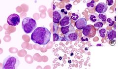 -blasts
-auer rods (faggot cells) --> only monoblast, promyelocyte, myleoblast
-anemia
-giant plt
-nRBCs
-pseudo HYPO seg (psuedo pelger huet) or HYPERseg neutrophils