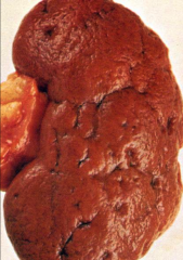 *Atherosclerotic Kidney.

*Kidneys are small and scarred as result of slowly  progressive ischemia.

*Note circular depressions along with other scars; these also represent ischemic change.

*Similar gross appearance might be seen in chronic...