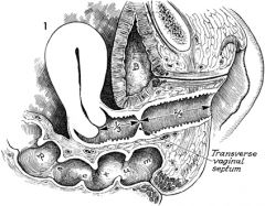 - failure for the upper and lower portions of the vagina to fuse during congenital development, resulting in a septum that divides the two portions.
- this usually occurs between the lower 2/3 and the upper 1/3
- It often presents as primary ameno...