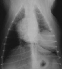 pulmonary mass 

notice acute angle with thoracic wall