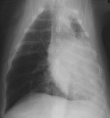 Mediastinal shift due to recumbent atalectasis (pull force)

The mediastinum (with the cardiac silhouette) is shifted to one side on the DV or VD radiograph

Due to:

Pull forces
- Recumbent atelectasis
   - They see this multiple times every day 