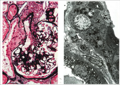 JUXTAGLOMERULAR CELL HYPERPLASIA in a kidney with a narrowed renal artery.

Left: Hypertrophied JGA cells are on top of and around the black, upside down "V" looking streak.

Right: EM of the JGA cells. Black dots are secretory granules that a...