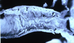 *Medial Fibroplasia, AKA Fibromuscular Dysplasia. Renal artery. Aorta on the right.