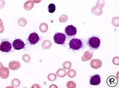-Hairy cells on peripheral smear
-TRAP positive cells
-CD19, 20, 22, 11c, 25, 103

-Rare B cell malignancy
-Fragile mononuclear cell