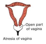 - when the lower vagina fails to develop and is replaced by fibrous tissue
- the ovaries, uterus, cervix and upper vagina all develop normally
- presents during puberty as primary amenorrhea and cyclic pelvic pain
- physical exam reveals the absen...