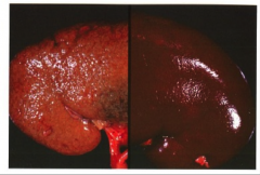 L: Hypertensive renal disease.
R: Normal kidney disease.

*Disregard color ∆. Note that normal kidney is smooth and glistening. On hypertensive kidney, capsule was adherent; this is why you see pocking, scarring, granularity. This is typical ...