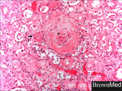 *HYALINE ARTERIOLOSCLEROSIS.
*The lesions are characterized by glassy thickening of arterial and arteriolar walls. In this section an involved arteriole (arrow) is adjacent to a sclerotic glomerulus (asterisk). Though seen in other conditions, hy...