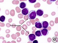 -CLL converts to PLL
-majority of circ = prolymphocyte --> not maturing

Prolymphocytes on peripheral smear
Strong CD20 and Sig activity
Also pos for CD19