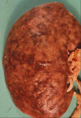 *Gross kidney in malignant HTN.
*Note brownish red areas on kidney surface; these represent areas of hemorrhage in the renal tissue.