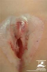 - inflammatory dermatosis that can be found on the vulva of women of all age groups, but has major significance in postmenopausal women, where it is associated with a 3-4% risk of vulvar skin cancer
- the atrophy that results from this condition c...