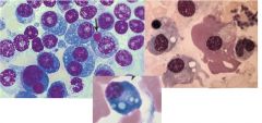 -Disorder of plasma cells: accum of plasma cells in BM and other locations
-older age
-environmental and occupational factors
-chromosome abnormalities, esp 13

3 PW: 
1.  Accel of plasma cells in the BM by cytokine IL-6
            -May de...