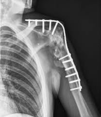 was the optimal position for arthrodesis of the shoulder joint