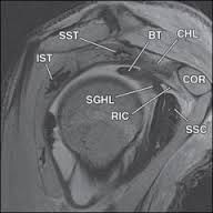 The rotator cuff is perforated anterosuperiorly by the coracoid process, which separates the anterior border of the supraspinatus tendon from the superior border of the subscapularis tendon, creating the triangular rotator interval, which is bridg...