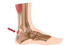 ddx:
- tendonitis +/- nodule
- bony spur