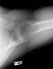 which form of osteoarthritis has a low association of rotator cuff tears