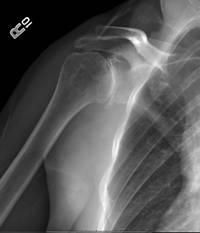 what 4 conditions commonly cause glenohumeral arthritis in the shoulder