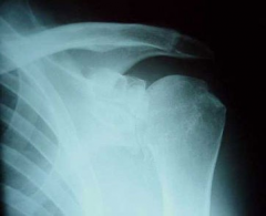 the patient presents with primary osteoarthritis the shoulder what is the incidence of rotator cuff tear along with the osteoarthritis 