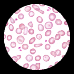 decreased hemoglobin concentration in pale cells