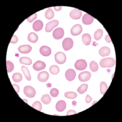 Pale and filled cells can both be seen following blood transfusion